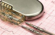 What to Ask Your Doctor Before Getting a Pacemaker for AFib